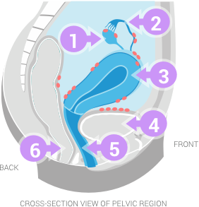 the five spots endometriosis can occur on a woman's body within the regions of her back, front and pelvic region