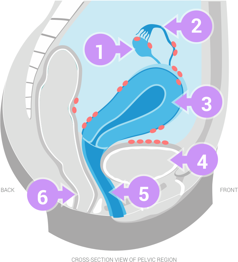 the five spots endometriosis can occur on a woman's body within the regions of her back, front and pelvic region